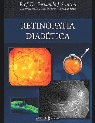 Retinopatia diabetica 1