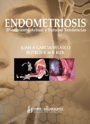 Endometriosis: Tratamiento Actual y Futuras Tendencias 1