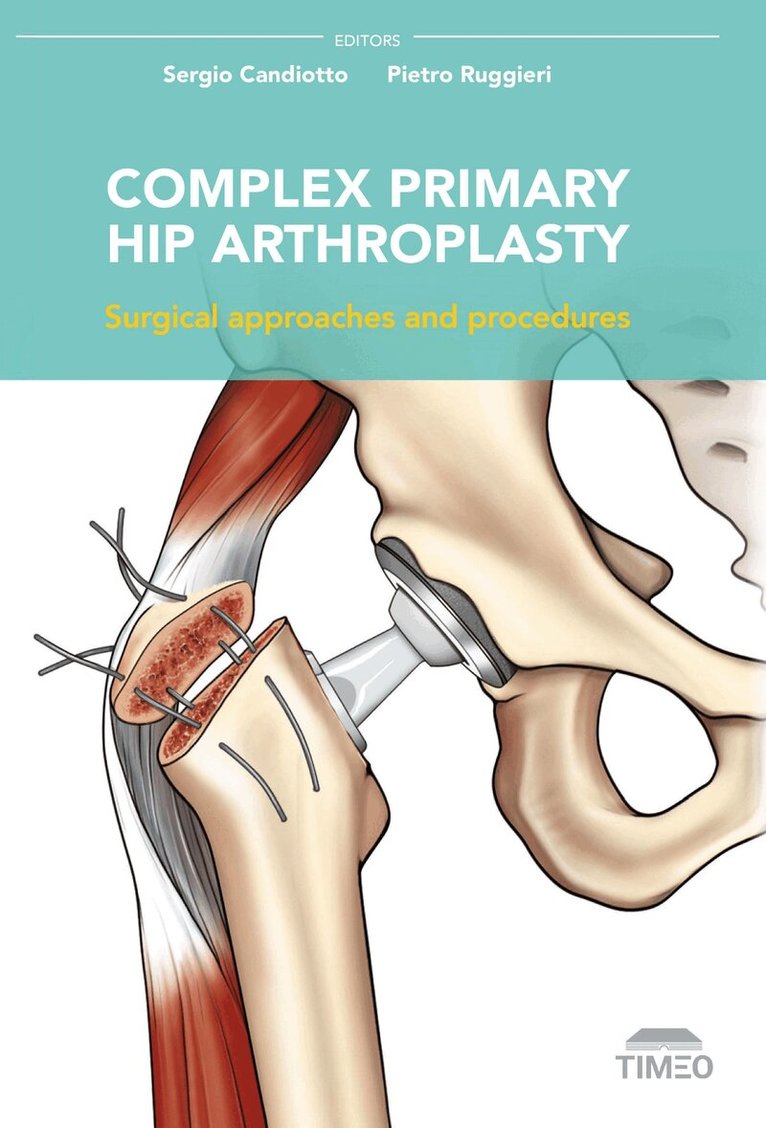 Complex Primary Hip Arthroplasty