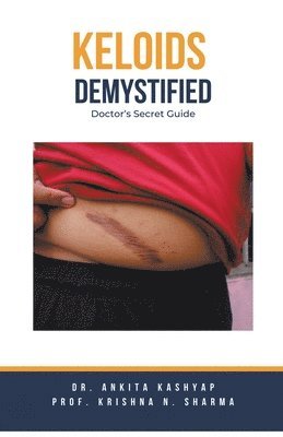 Keloids Demystified 1