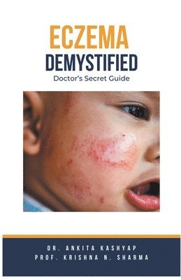 bokomslag Eczema Demystified