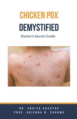 bokomslag Chickenpox Demystified