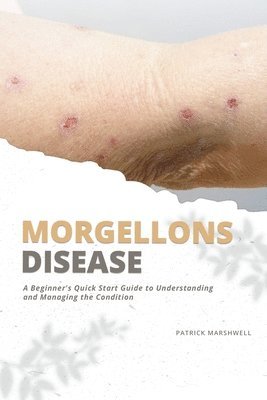 Patrick Marshwell - Morgellons Disease: A Beginner's Quick Start Guide to Understanding and Managing the Condition, Häftad