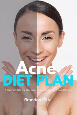 Brandon Gilta - Acne Diet Plan, Häftad. Tillgänglighet: Lägg i varukorg