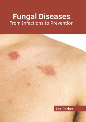 Fungal Diseases: From Infections to Prevention 1